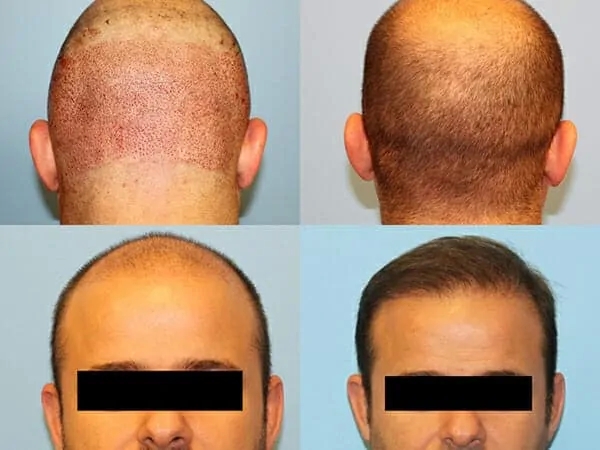 Understanding the Cost of Hair Transplant Surgery in New York