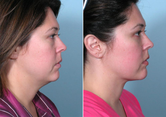 Explore Mini Neck Lifts Close By: Your Neck Rejuvenation